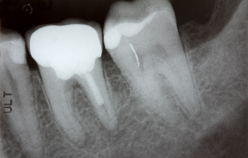 rentgen zobni