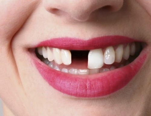 Zakaj nadomestiti manjkajoči zob?